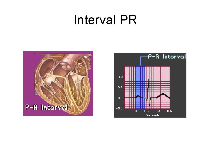 Interval PR 