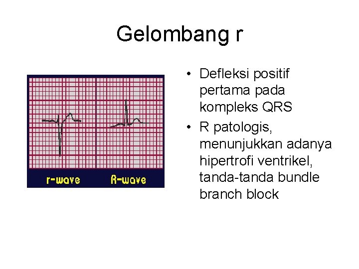 Gelombang r • Defleksi positif pertama pada kompleks QRS • R patologis, menunjukkan adanya