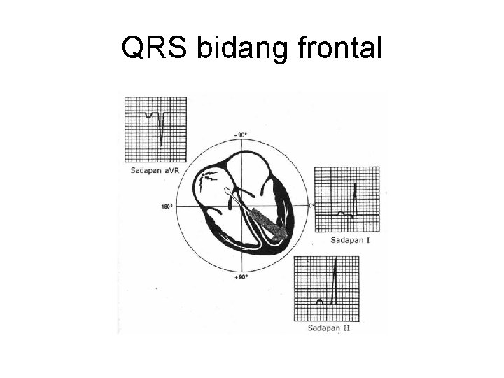 QRS bidang frontal 