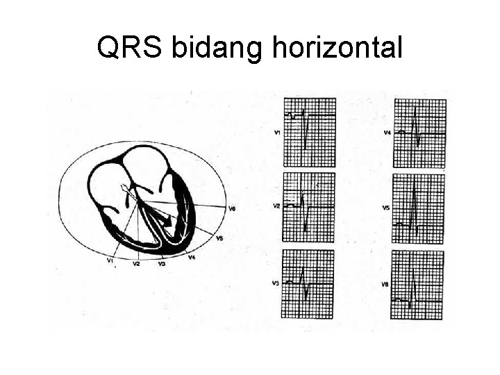 QRS bidang horizontal 