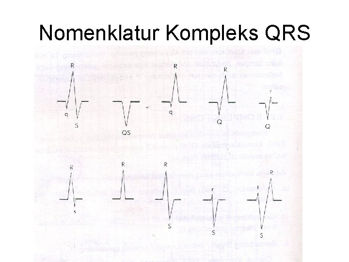 Nomenklatur Kompleks QRS 