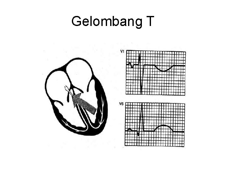 Gelombang T 