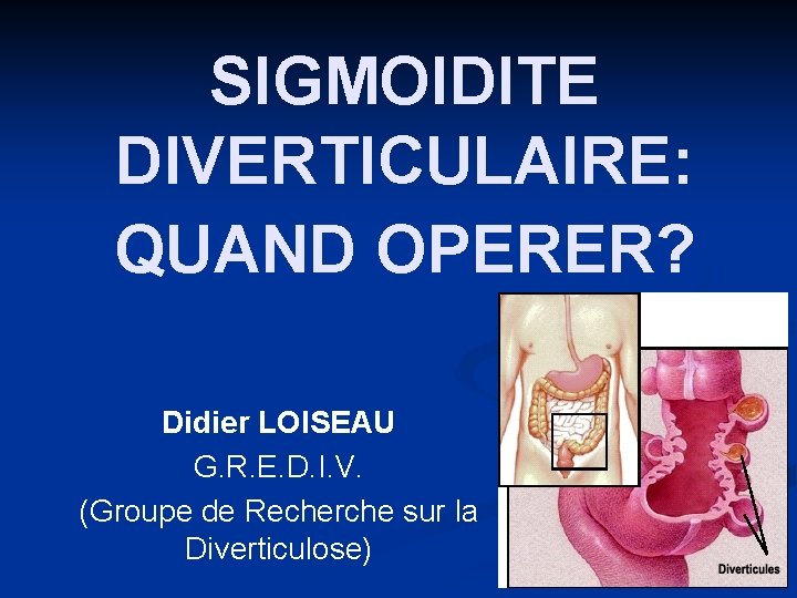 SIGMOIDITE DIVERTICULAIRE: QUAND OPERER? Didier LOISEAU G. R. E. D. I. V. (Groupe de