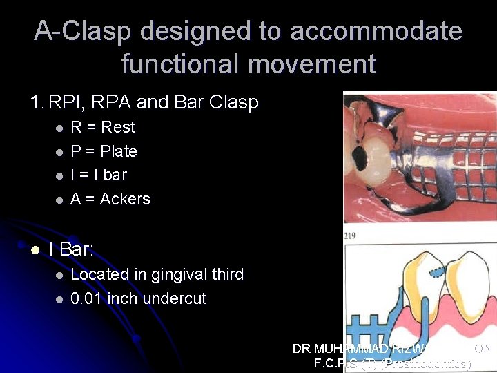 A-Clasp designed to accommodate functional movement 1. RPI, RPA and Bar Clasp l l