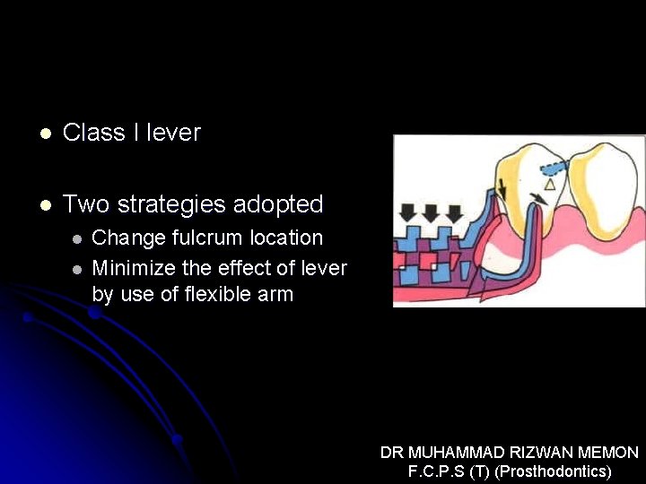 l Class I lever l Two strategies adopted l l Change fulcrum location Minimize