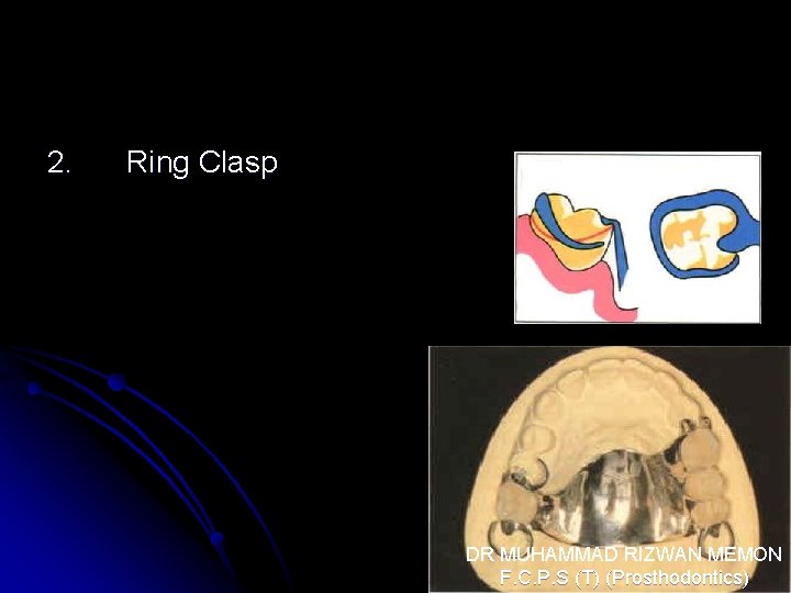 2. Ring Clasp DR MUHAMMAD RIZWAN MEMON F. C. P. S (T) (Prosthodontics) 