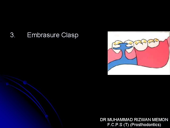 3. Embrasure Clasp DR MUHAMMAD RIZWAN MEMON F. C. P. S (T) (Prosthodontics) 