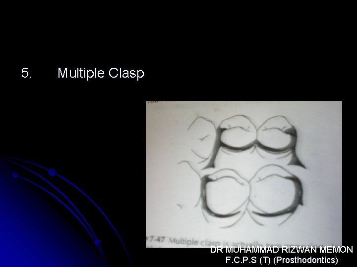 5. Multiple Clasp DR MUHAMMAD RIZWAN MEMON F. C. P. S (T) (Prosthodontics) 
