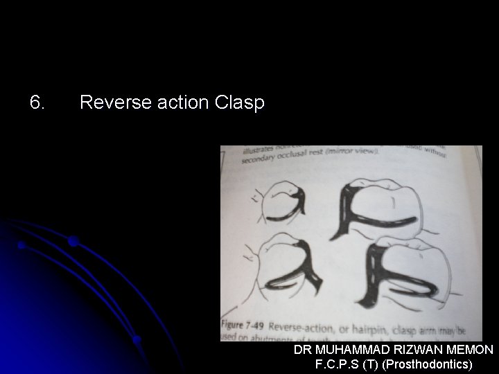 6. Reverse action Clasp DR MUHAMMAD RIZWAN MEMON F. C. P. S (T) (Prosthodontics)