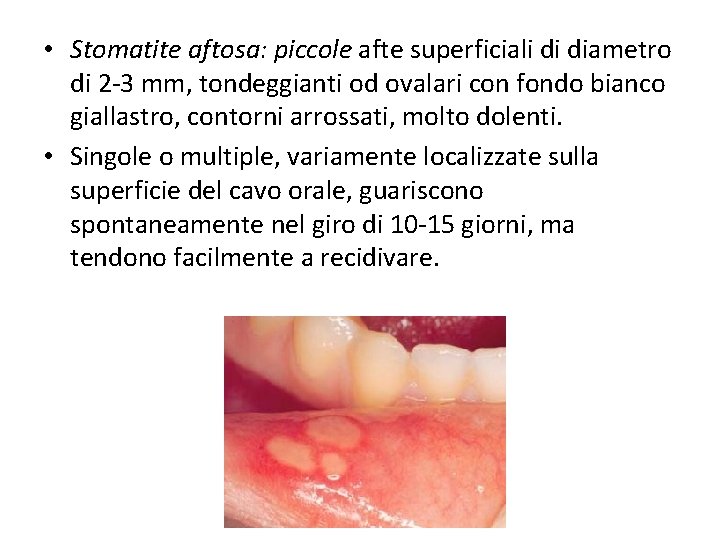  • Stomatite aftosa: piccole afte superficiali di diametro di 2 -3 mm, tondeggianti