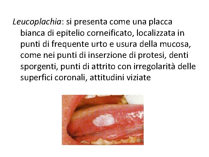 Leucoplachia: si presenta come una placca bianca di epitelio corneificato, localizzata in punti di