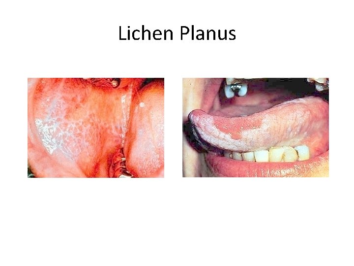 Lichen Planus 