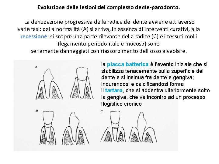 Evoluzione delle lesioni del complesso dente-parodonto. La denudazione progressiva della radice del dente avviene