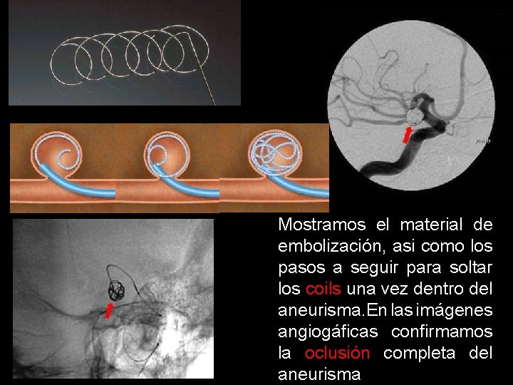 Mostramos el material de embolización, asi como los pasos a seguir para soltar los Mostramos el material de embolización, asi como los pasos a seguir para soltar los