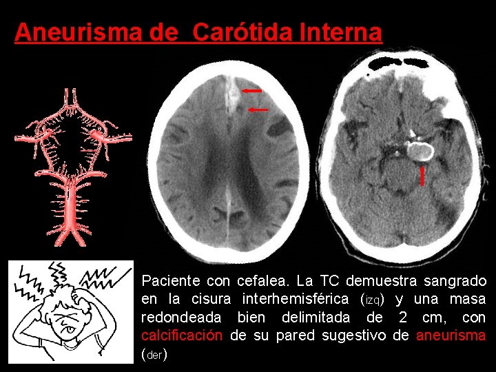 Aneurisma de Carótida Interna Paciente con cefalea. La TC demuestra sangrado en la cisura Aneurisma de Carótida Interna Paciente con cefalea. La TC demuestra sangrado en la cisura