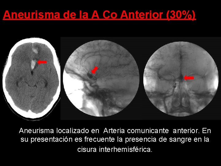 Aneurisma de la A Co Anterior (30%) Aneurisma localizado en Arteria comunicanterior. En su Aneurisma de la A Co Anterior (30%) Aneurisma localizado en Arteria comunicanterior. En su
