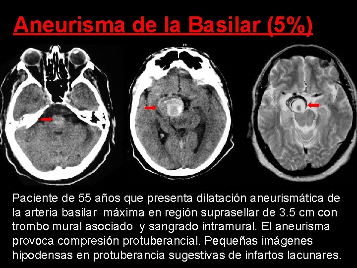 Aneurisma de la Basilar (5%) Paciente de 55 años que presenta dilatación aneurismática de Aneurisma de la Basilar (5%) Paciente de 55 años que presenta dilatación aneurismática de