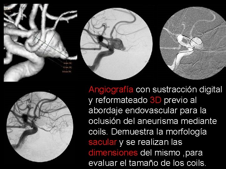 Angiografía con sustracción digital y reformateado 3 D previo al abordaje endovascular para la Angiografía con sustracción digital y reformateado 3 D previo al abordaje endovascular para la