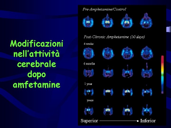 Modificazioni nell’attività cerebrale dopo amfetamine 