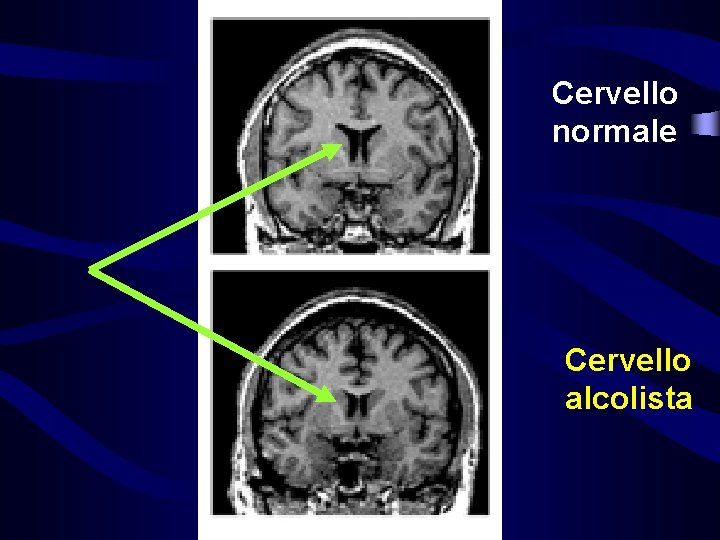 Cervello normale Cervello alcolista 