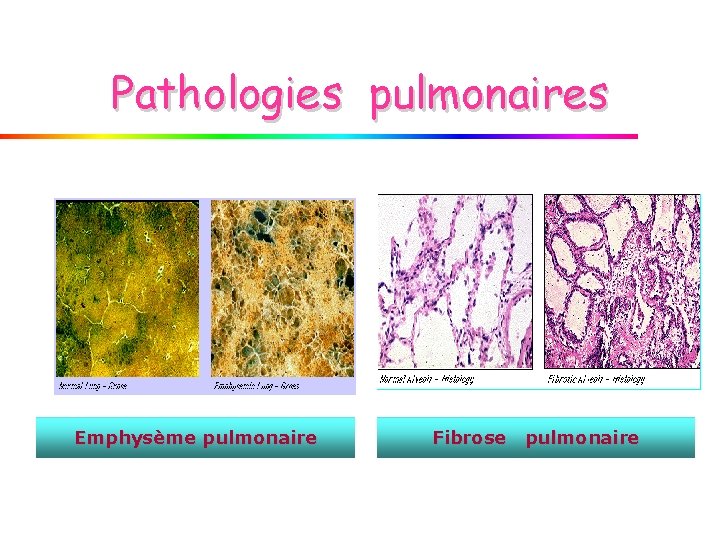 Pathologies pulmonaires Emphysème pulmonaire Fibrose pulmonaire 