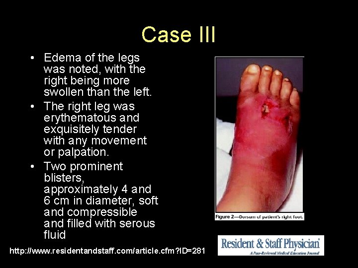 Case III • Edema of the legs was noted, with the right being more