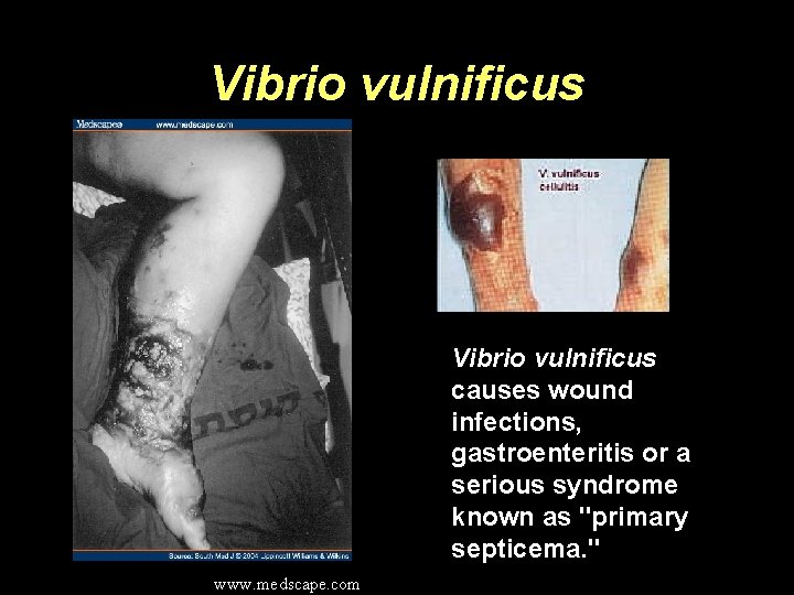 Vibrio vulnificus causes wound infections, gastroenteritis or a serious syndrome known as "primary septicema.