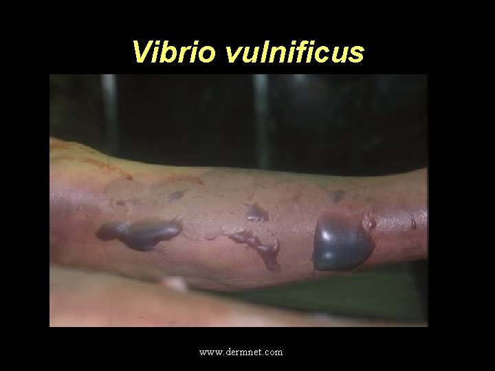 Vibrio vulnificus www. dermnet. com 