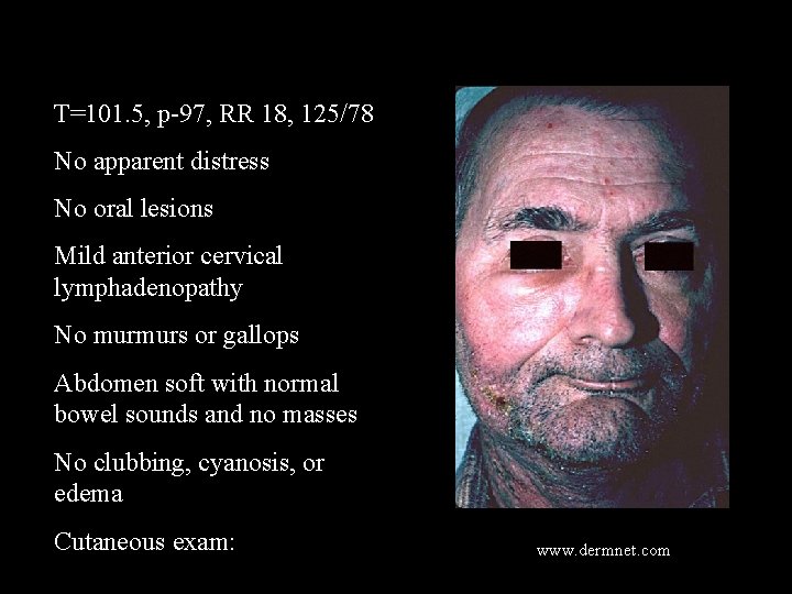 T=101. 5, p-97, RR 18, 125/78 No apparent distress No oral lesions Mild anterior