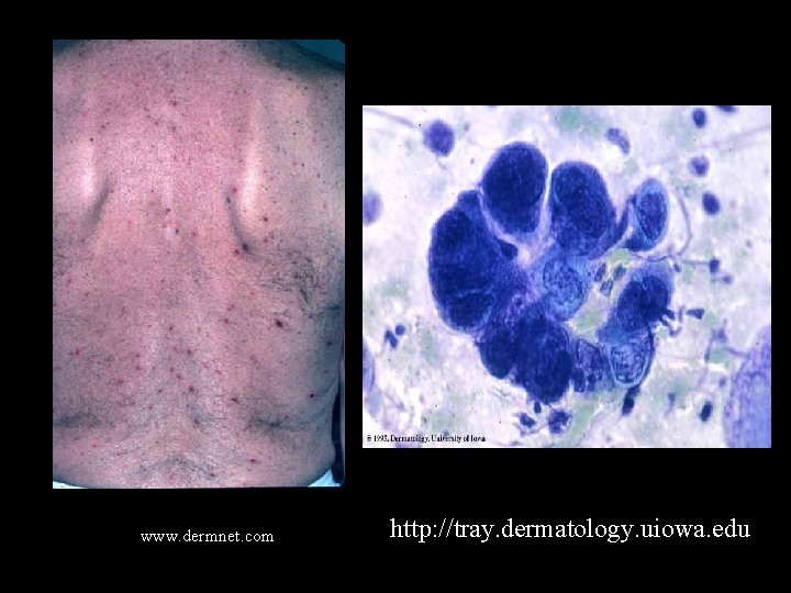 www. dermnet. com http: //tray. dermatology. uiowa. edu 