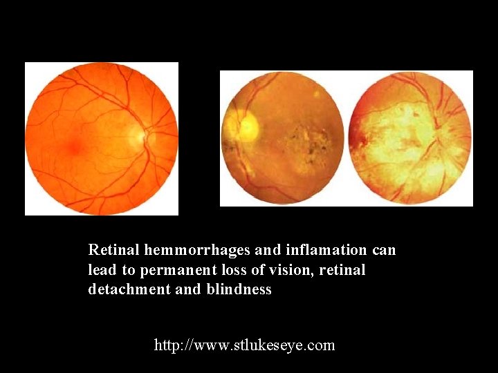 Retinal hemmorrhages and inflamation can lead to permanent loss of vision, retinal detachment and