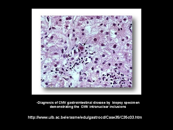  • Diagnosis of CMV gastrointestinal disease by biopsy specimen demonstrating the CMV intranuclear