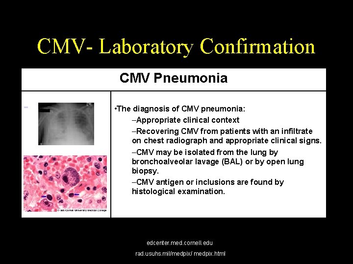 CMV- Laboratory Confirmation CMV Pneumonia • The diagnosis of CMV pneumonia: –Appropriate clinical context