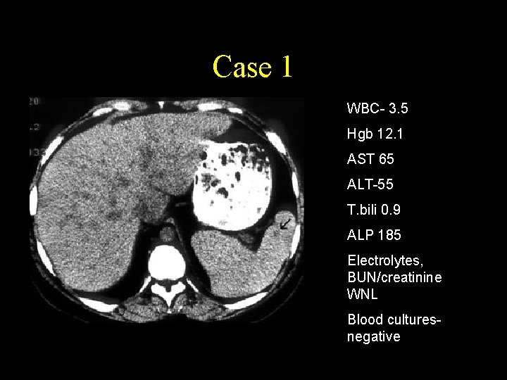 Case 1 WBC- 3. 5 Hgb 12. 1 AST 65 ALT-55 T. bili 0.