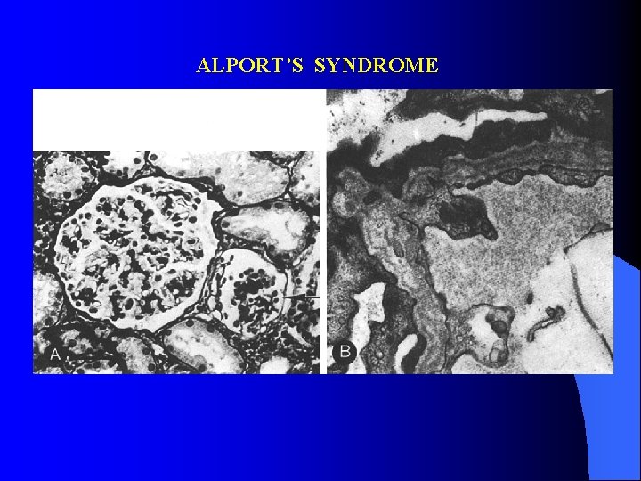 ALPORT’S SYNDROME 