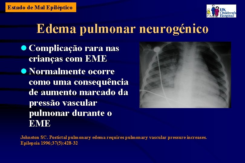 Estado de Mal Epiléptico Edema pulmonar neurogénico l Complicação rara nas crianças com EME