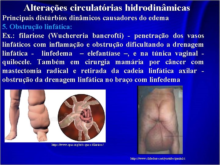 Alterações circulatórias hidrodinâmicas Principais distúrbios dinâmicos causadores do edema 5. Obstrução linfática: Ex. :