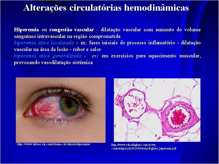 Alterações circulatórias hemodinâmicas Hiperemia ou congestão vascular - dilatação vascular com aumento do volume