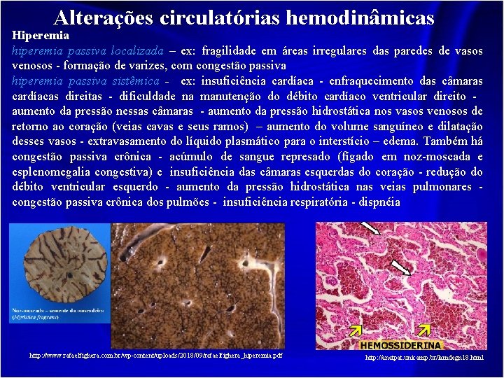 Alterações circulatórias hemodinâmicas Hiperemia hiperemia passiva localizada – ex: fragilidade em áreas irregulares das