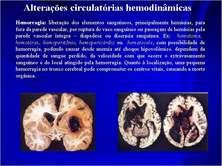 Alterações circulatórias hemodinâmicas Hemorragia: liberação dos elementos sanguíneos, principalmente hemácias, para fora da parede
