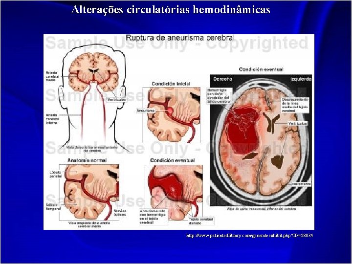Alterações circulatórias hemodinâmicas http: //www. patientedlibrary. com/generateexhibit. php? ID=28034 