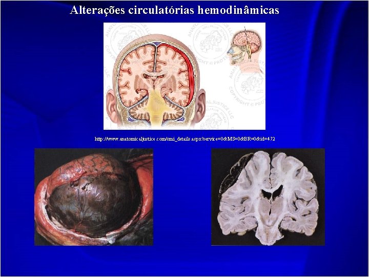Alterações circulatórias hemodinâmicas http: //www. anatomicaljustice. com/smi_details. aspx? service=0&MS=0&BR=0&id=472 