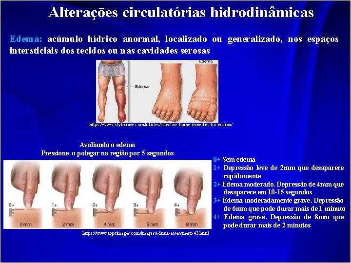 Alterações circulatórias hidrodinâmicas Edema: acúmulo hídrico anormal, localizado ou generalizado, nos espaços intersticiais dos