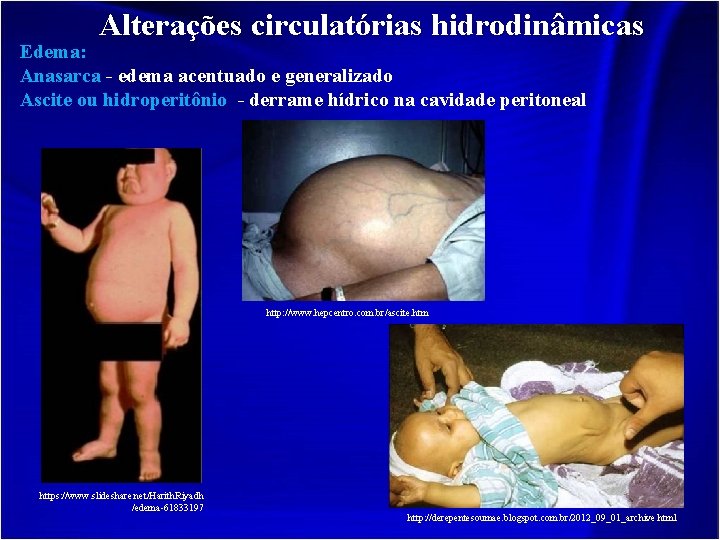Alterações circulatórias hidrodinâmicas Edema: Anasarca - edema acentuado e generalizado Ascite ou hidroperitônio -