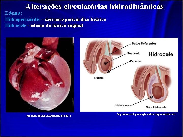 Alterações circulatórias hidrodinâmicas Edema: Hidropericárdio - derrame pericárdico hídrico Hidrocele - edema da túnica