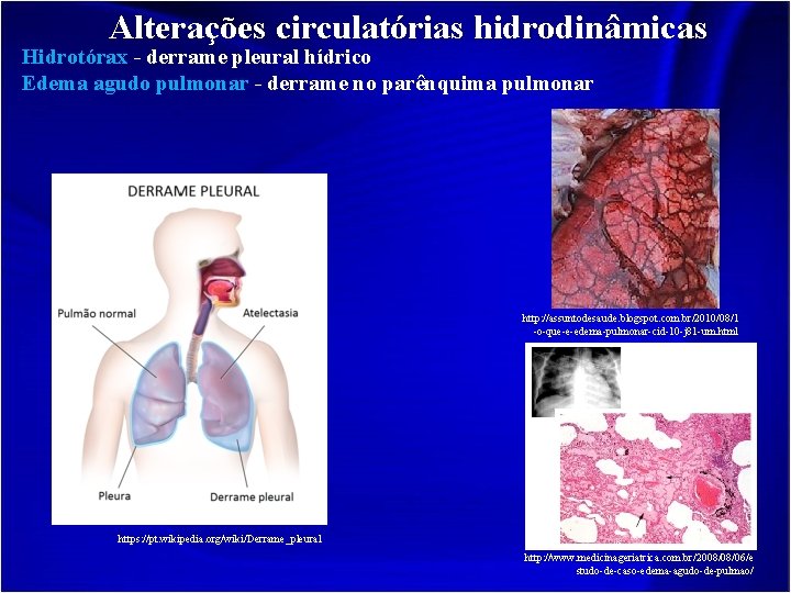 Alterações circulatórias hidrodinâmicas Hidrotórax - derrame pleural hídrico Edema agudo pulmonar - derrame no