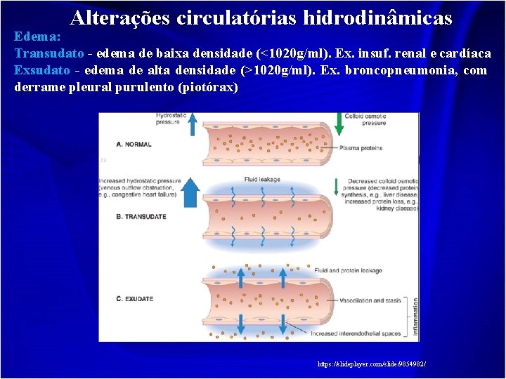 Alterações circulatórias hidrodinâmicas Edema: Transudato - edema de baixa densidade (<1020 g/ml). Ex. insuf.
