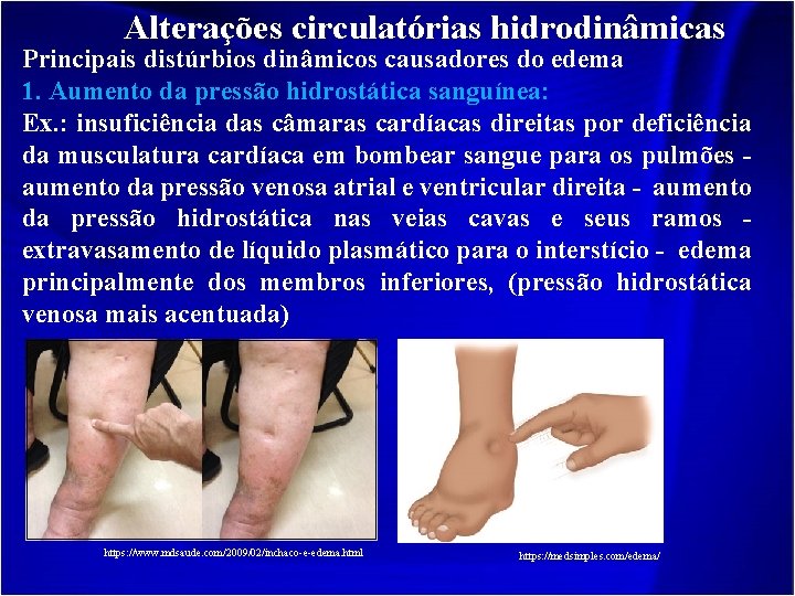 Alterações circulatórias hidrodinâmicas Principais distúrbios dinâmicos causadores do edema 1. Aumento da pressão hidrostática