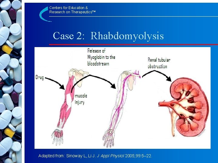 Centers for Education & Research on Therapeutics™ Case 2: Rhabdomyolysis Adapted from: Sinoway L,