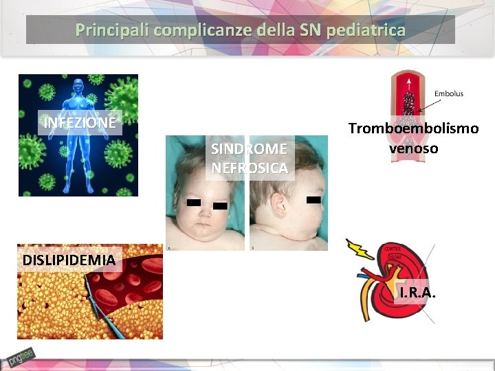 Principali complicanze della SN pediatrica INFEZIONE SINDROME NEFROSICA Tromboembolismo venoso DISLIPIDEMIA I. R. A.